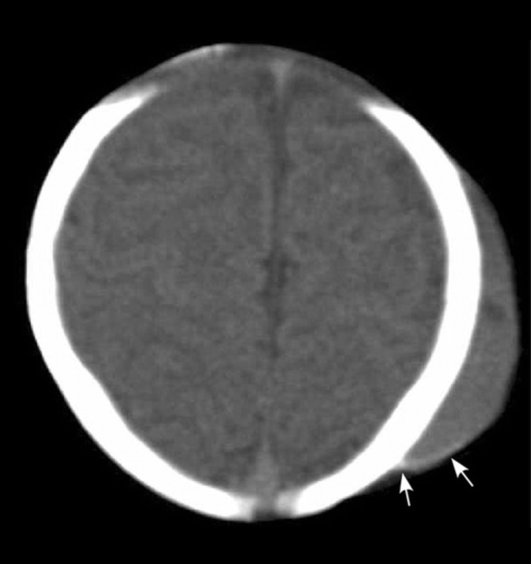 5- Cephalhematomaيعنى كدمه فى ال scalp بره الدماغ يعنى متقلقش اوى لو مفيش غيرها و تمشى conservativeهتشوفها فى ال CT برضو بس مش بتتشخص بال CT لأنها باينه قدامكاحنا بنعمل الاشعه عشان نتأكد أن مفيش حاجه جوه الدماغهنشوف تجمع دموى تحت الجلد و بره عضم الجمجمه