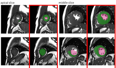 Radiology_AI's tweet photo. MRI Manufacturer Shift and Adaptation https://t.co/xubwpQWM3O @DrQtao #adaptableAI #DeepLearning #MachineLearning https://t.co/GIPADegpOJ