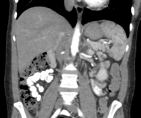 Splenic mass in a 48-year-old female.