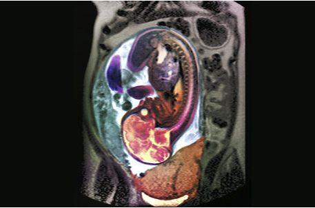 dukeobgyn's tweet photo. Can you #diagnosethis from the latest #gynecology edition of @dukehealth #ClinicalPracticeToday? Test your skills: What is the diagnosis if the patient presents with irregular uterine bleeding for nearly 30 weeks? Click to find out: https://t.co/J417ZW6QzL https://t.co/3JD5BG7cfk