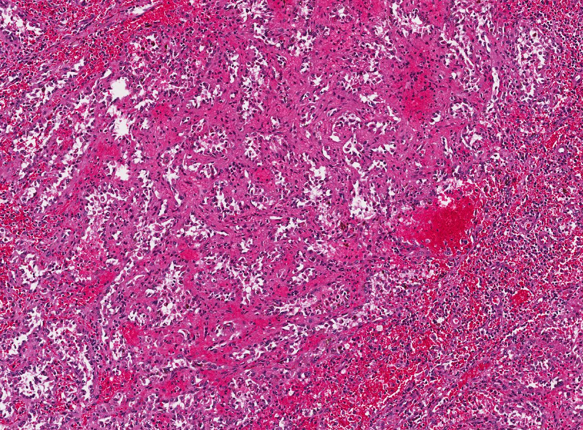 Gross reveals multiple vaguely well-circumscribed masses within the otherwise normal splenic pulp.