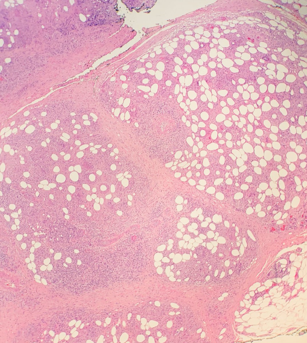 AlawamiSarah's tweet photo. Erythema Induratum (Nodular Vasculitis): lobular panniculitis, granulomas &amp; fat necrosis, and vasculitis #dermpath https://t.co/jCWdXAivyB