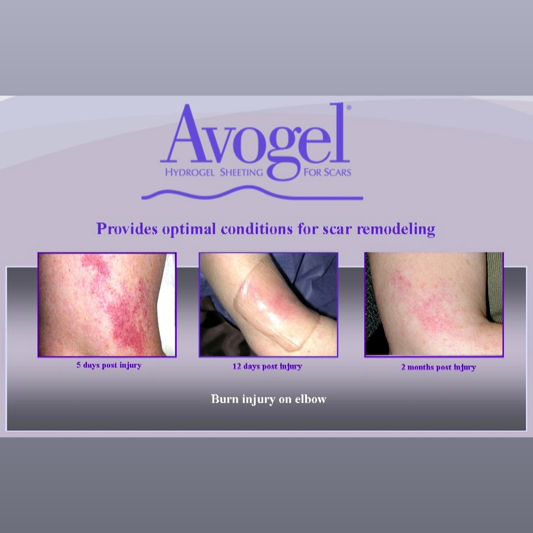 AvocetCorp's tweet photo. Scarring can leave an impact on your confidence. Avogel is a hydrogel patch designed to reduce the overall appearance, texture and skin color of scarring. 
#skin #scar #scarring  #hypertrophicscarring #selfcare #scarstories #burn #burntherapy #burncare #cuts #avocet #avogel https://t.co/oK0N0PLka1