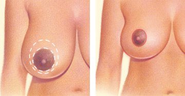 Incision types1- Circular pattern around the Areola2-A keyhole or racquet-shaped pattern with an incision around the areola and vertically down to the breast crease3-An inverted T or anchor-shaped incision pattern