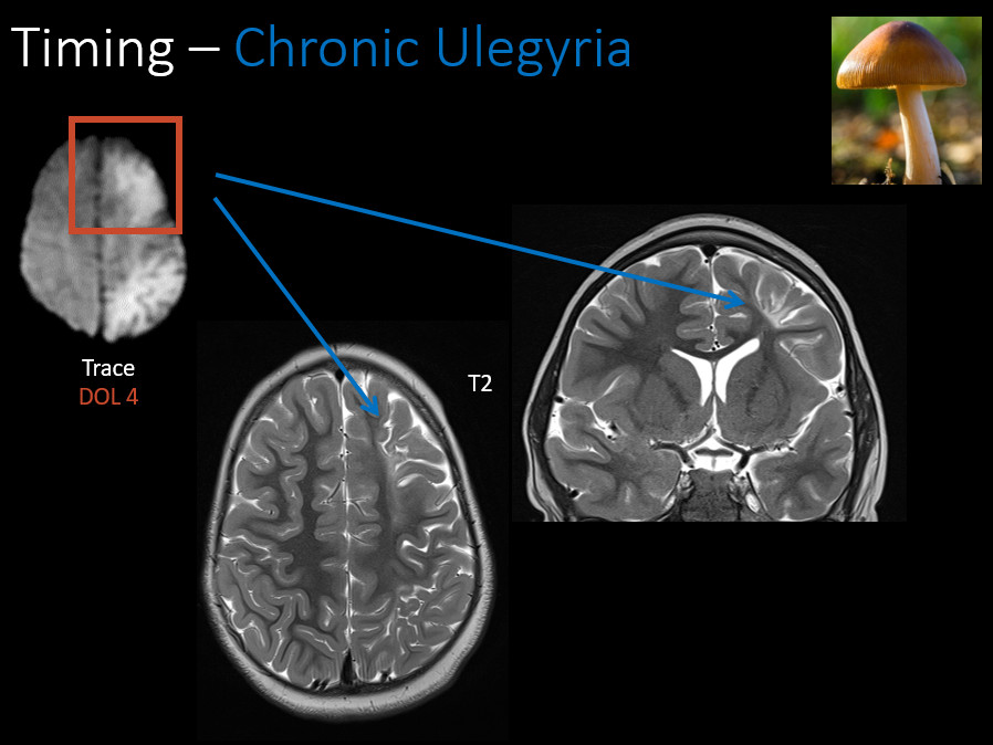 MirskyDavid's tweet photo. Excellent overview of Neonatal Encephalopathy by my esteemed colleague @IlanaNeuberger!  

Summer virtual lecture series between @PedsRadsColo and @LurieNeuroRads = Fun Fun Fun!!! https://t.co/iMRCux0KFR