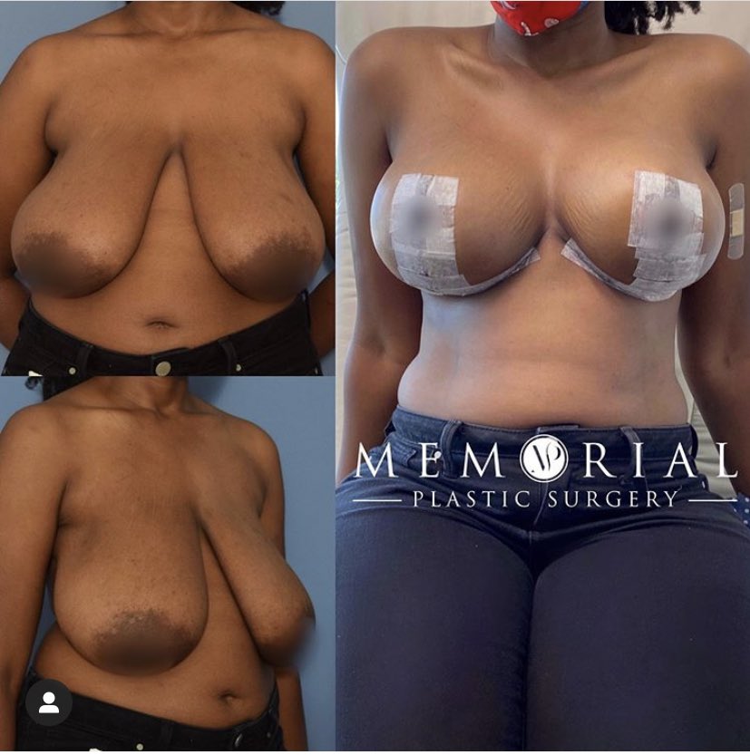 Again, if your surgeon knows how to PROPERLY reposition your existing breast tissue , you don’t NEED an implant.