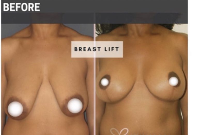 Again, if your surgeon knows how to PROPERLY reposition your existing breast tissue , you don’t NEED an implant.