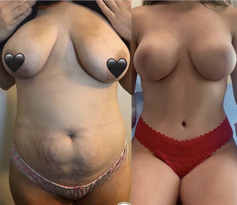 An implant will better achieve the “perky” look , where you have cleavage without a bra. Implants provide better contours and can help reshape, especially when your natural shape isn’t “aesthetically pleasing”.