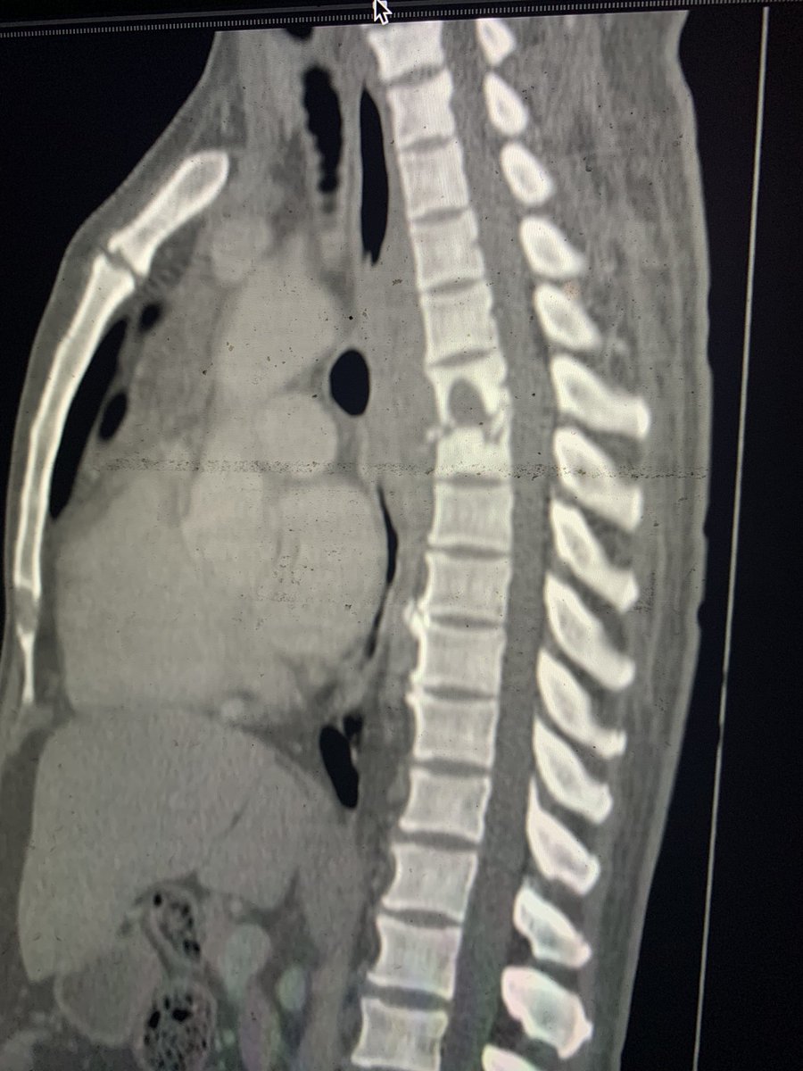GRadiologists's tweet photo. 55 yr old man with paraplegia. Is this Pott disease? Credit Dr Jimah https://t.co/9Gc3HUUFch
