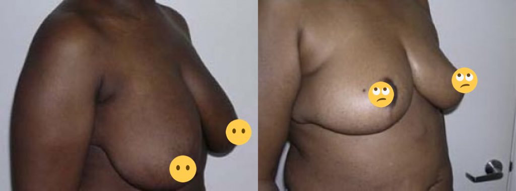 Surgeons that are trained in advanced methods ( you gotta pay for the names of those  #SorryNotSorry ) produce the beautiful results I featured above. Surgeons that don’t have that advance training will Push you towards an implant or produce undesirable results like these....
