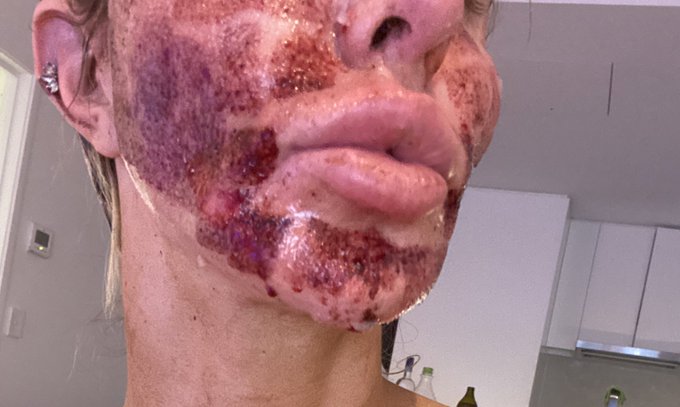 Update -I had my laser resurfacing. This photo was 10 days ago on day 1, I had been nerve blocked and<a href="/tag/3some"class="tags"><span>#3some</span></a>