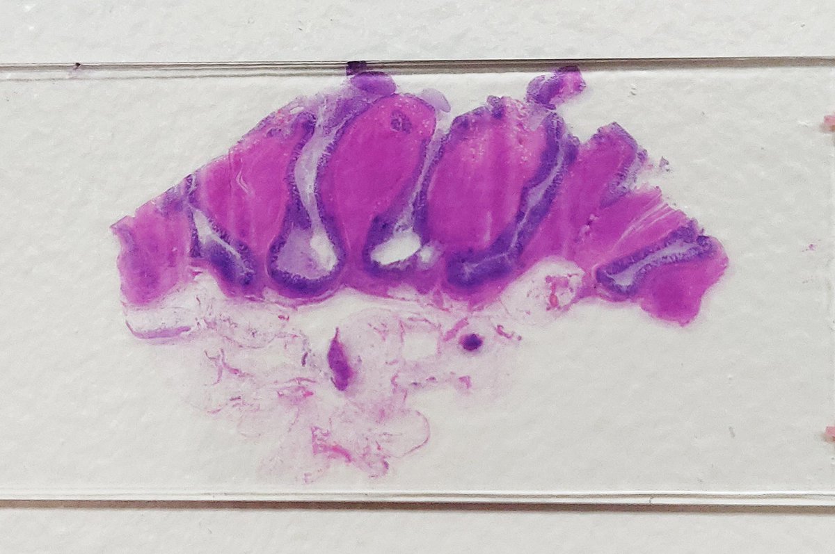 Diverticular disease. #pathology #pathtwitter #GIpath #LPpath @EinsteinMed @EinsteinPath @DrKarenPinder @anjuthevirgo @anueru432 @AmberMBerumen @MaxwellRoth5 @yokoda_md @c_castrodad @DrVish @Dr_Brian_Cox @AnitaArackal @DrGeeONE