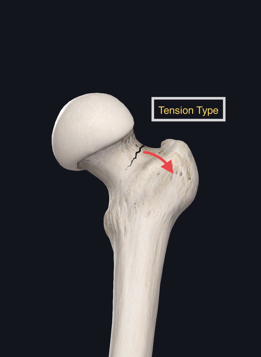 (3/4) For purposes of this thread, focus is on femoral neck. Tension/Distaction: Top side of neck (left). Considered high risk. Can displaceCompressive: Bottom side (right): Considered lower risk. Common in runnersDisplaced fracture - requires surgery