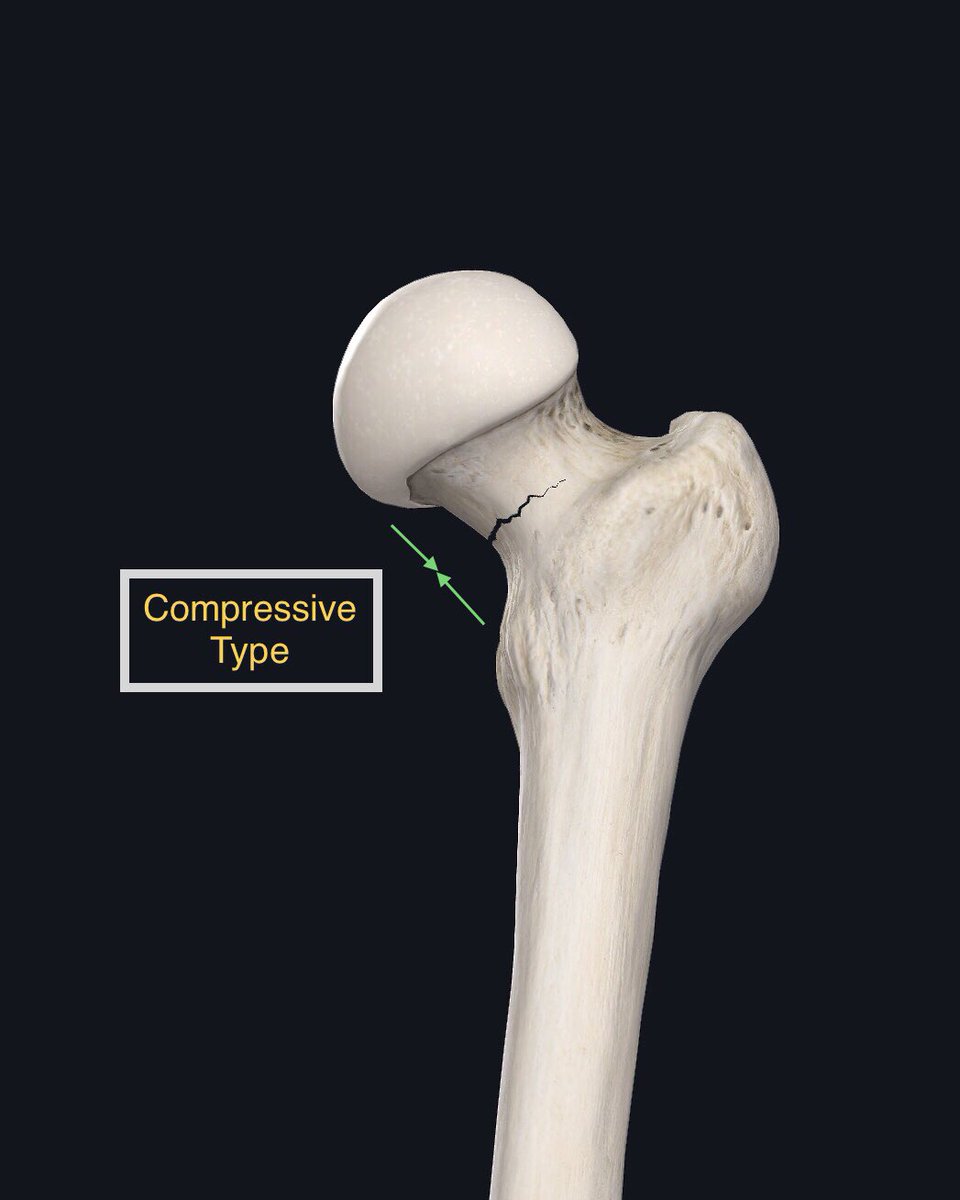 (3/4) For purposes of this thread, focus is on femoral neck. Tension/Distaction: Top side of neck (left). Considered high risk. Can displaceCompressive: Bottom side (right): Considered lower risk. Common in runnersDisplaced fracture - requires surgery