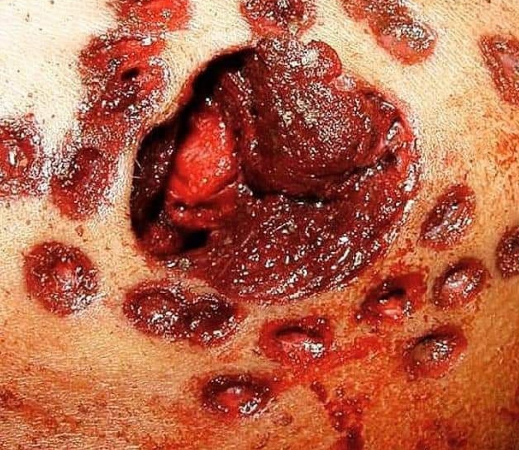 ForensicWorld31's tweet photo. Multiple projectile wound fired by Gun🔫
X ray shows how se pelletes entered inside the body, causing the imminent Death of the Subject in Question.
#Ballistics
#ForensicScience
#Forensics
#postmortemExamination https://t.co/xD9KlwnRe5