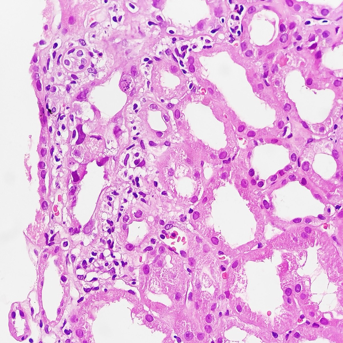 MVankalakunti's tweet photo. Yet another case๐
#C4d substantiating the suspicion of #bkvirus #Polyoma ๐
C4d - Granular dep along TBM
DIF - IgG Granular dep along TBM
#renalpath #nephrology #allograft #NephTwitter #Nephpearls @ISNeducation https://t.co/YAfcexMlwz