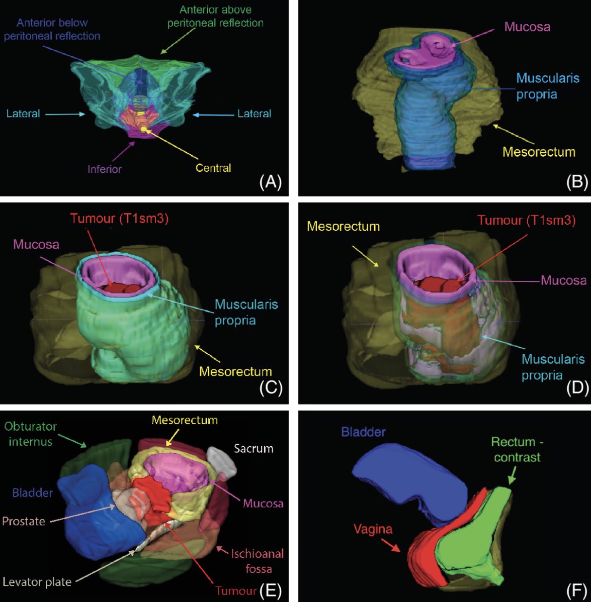 Rectal 3D MRI modelling for benign and malignant disease bjssjournals.onlinelibrary.wiley.com/doi/10.1002/bj… #surgicalplanning #training #patienteducation @ImperialSandC @ParisTekkis @DrOliverWarren @DrSarahCMills @shrasheed @ChelwestFT @royalmarsdenNHS