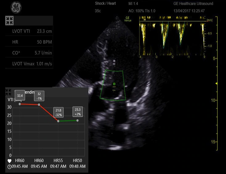 Quickly trend VTI over time with the simple to use VTI Trending Tool