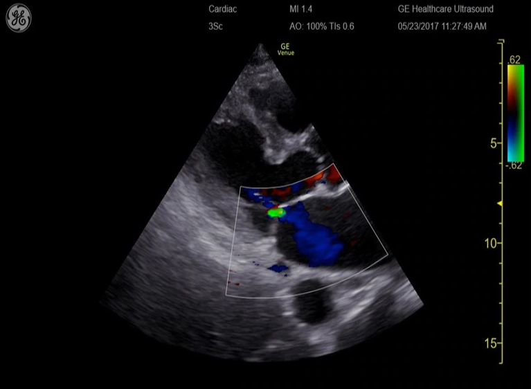 Excellent colour flow sensitivity to demonstrate regurgitant jets as in this mitral valve image with the 3Sc-RS 