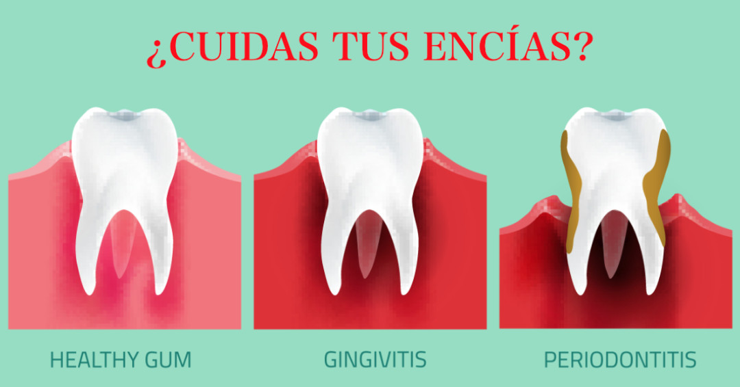 Odola agertzen da hortzak garbitzerakoan? Hortzoiak zaindu!
.
.
¿Sangras cuando te lavas los dientes? ¡Cuida tus encías!