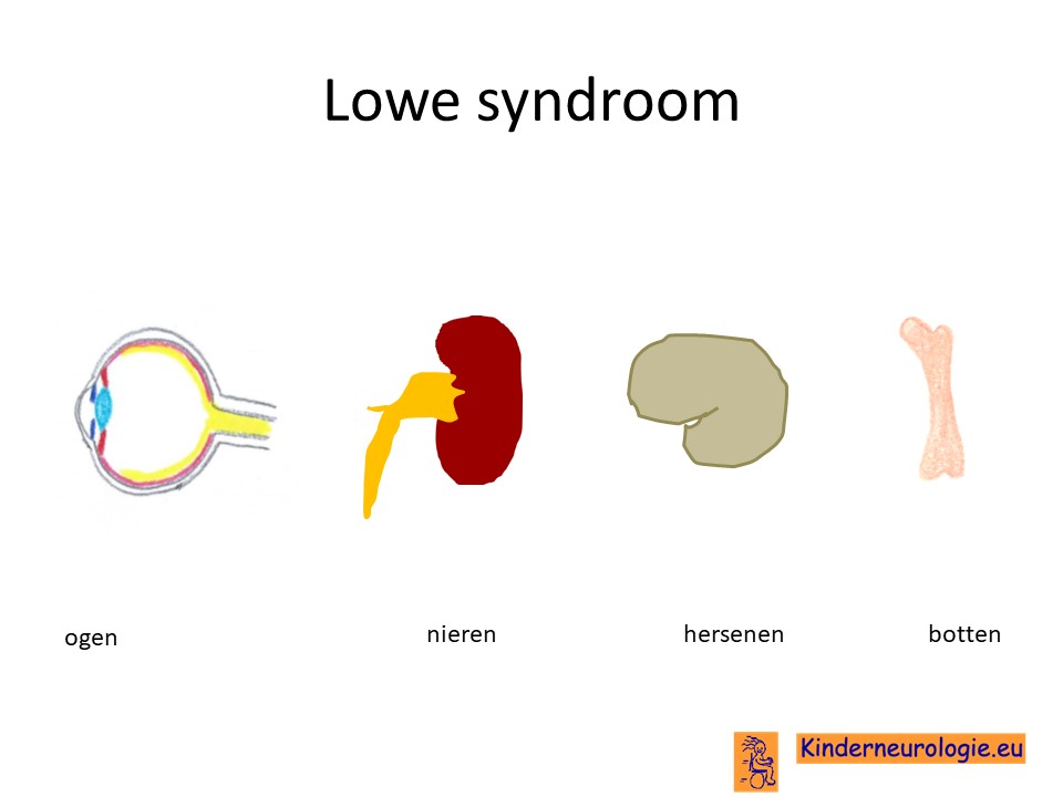Wie heeft er ervaring met het zeer zeldzame Lowe syndroom? Dit kan in een thuissituatie zijn of werk gerelateerd (medisch/begeleiding/verzorging). We komen heel graag in contact! 
Bel/app naar 06 46 94 15 14 of laat hieronder een bericht achter en wij contacten jou!