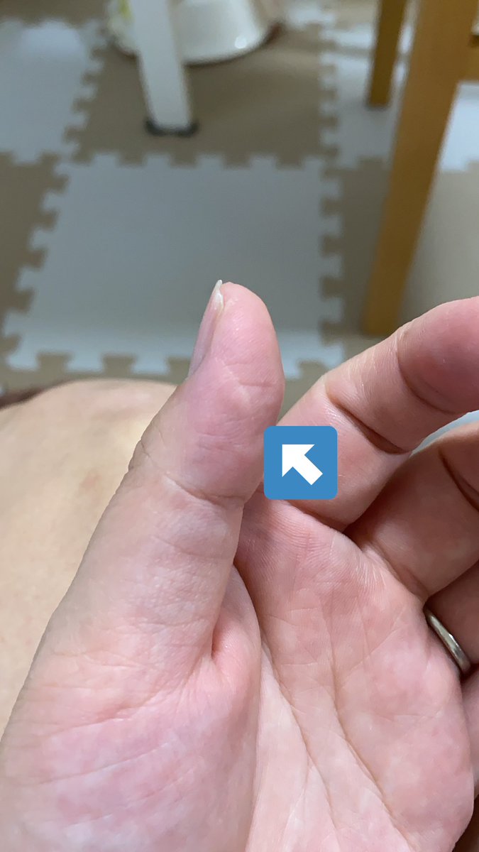 はる 1y10m 切った跡もだけど やけどの白いところが 娘ちゃん 自分とは別の人 のお薬使うのってあんまり推奨されてないから小声なんだけど ヘパリンとかヒルドイドとか娘ちゃん処方されたりしてない アットノンと成分似てて 傷跡消えるよ はる 1y10m 切った跡もだけど やけどの白いところが 娘ちゃん 自分とは別の人 のお薬使うのってあんまり推奨されてないから小声なんだけど ヘパリンとかヒルドイドとか娘ちゃん処方されたりしてない アットノンと成分似てて 傷跡消えるよ