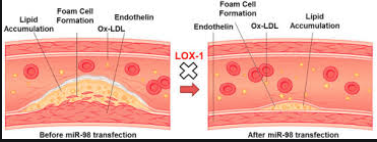 How is all this confusion possible? Because LDL does play a role in atherosclerosis.It's just that the LDL that is taken up by foam cells that form atherosclerotic plaques / lesions is always OXIDIZED. It's not healthy, vitamin rich, fluffy LDL particles.