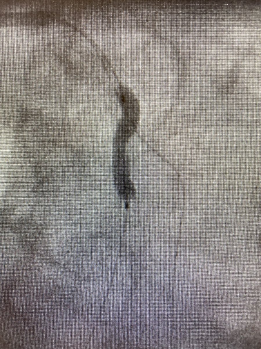 Stent 3.0 x 33mm, suboptimal expanded due to Ca++