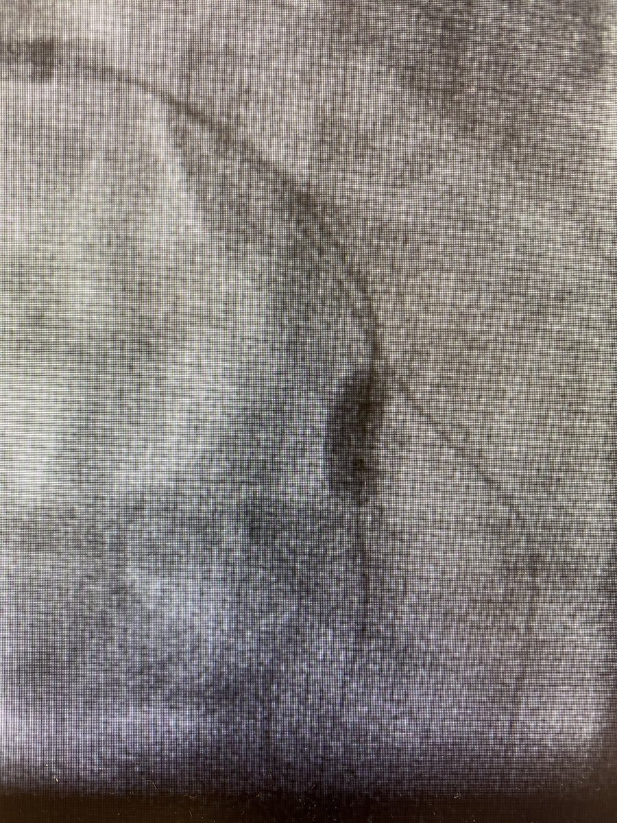 PostStenting: NC 3.0 x 6 mm needed to go up to 24 atm for full expansion. No burst but then Perforation, Typ III. See above