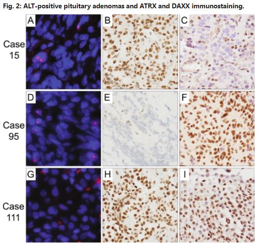 Fausto Rodriguez (@frodrigueznp) on Twitter photo tl/dr: Alternative lenghtening of telomeres (ALT) and ATRX/DAXX alterations overrepresented in rec pit adenomas. Our paper in print:
pubmed.ncbi.nlm.nih.gov/32203094/
<a href="/orbitcme/">Orbit CME</a> and @pathologycast. Earn SAM for this article at orbitcme.com/join/pathcast
#pathcast #pathology #neuropathology tl/dr: Alternative lenghtening of telomeres (ALT) and ATRX/DAXX alterations overrepresented in rec pit adenomas. Our paper in print:
pubmed.ncbi.nlm.nih.gov/32203094/
<a href="/orbitcme/">Orbit CME</a> and @pathologycast. Earn SAM for this article at orbitcme.com/join/pathcast
#pathcast #pathology #neuropathology