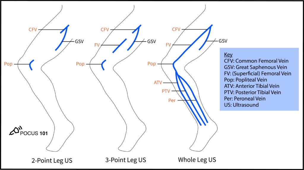 4 We recommend the 3-point protocol https://pocus101.com/dvt Compress at: Saphenofemoral Junction Bifurcation of CFV into Deep Femoral Vein and Femoral Vein Popliteal Vein up to the trifurcationThis figure shows the differences b/n protocols