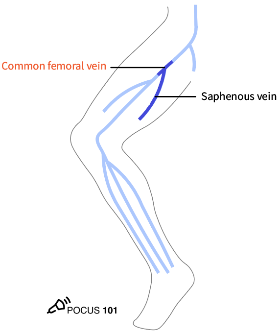 7 Slide the probe 1-2 cm down the patient’s leg to find where the great saphenous vein branches off of the CFV. Apply compression. https://pocus101.com/dvt 