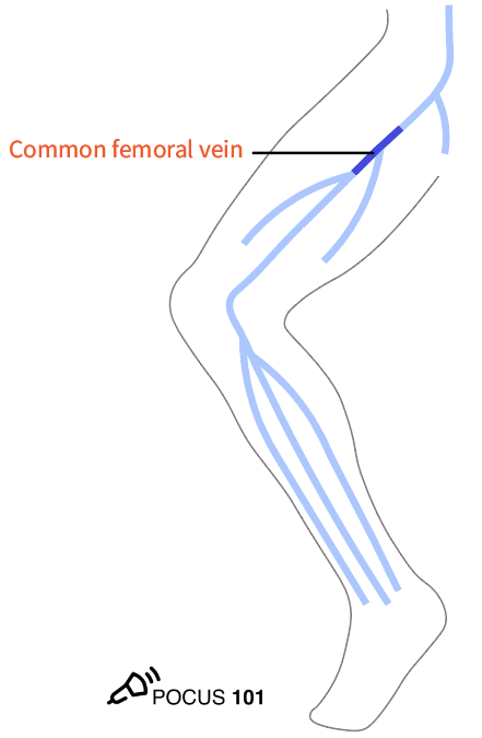 6 Apply gel onto the probe and place it along the inguinal ligament.Orient the probe perpendicular to the skin with indicator facing the patient’s right to obtain the transverse view of the Common Femoral Vein and Common Femoral Artery. Compress. https://pocus101.com/dvt 