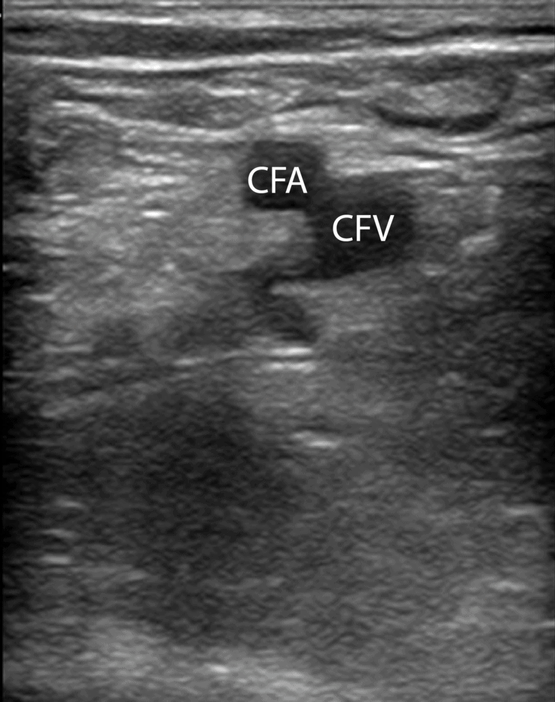 6 Apply gel onto the probe and place it along the inguinal ligament.Orient the probe perpendicular to the skin with indicator facing the patient’s right to obtain the transverse view of the Common Femoral Vein and Common Femoral Artery. Compress. https://pocus101.com/dvt 