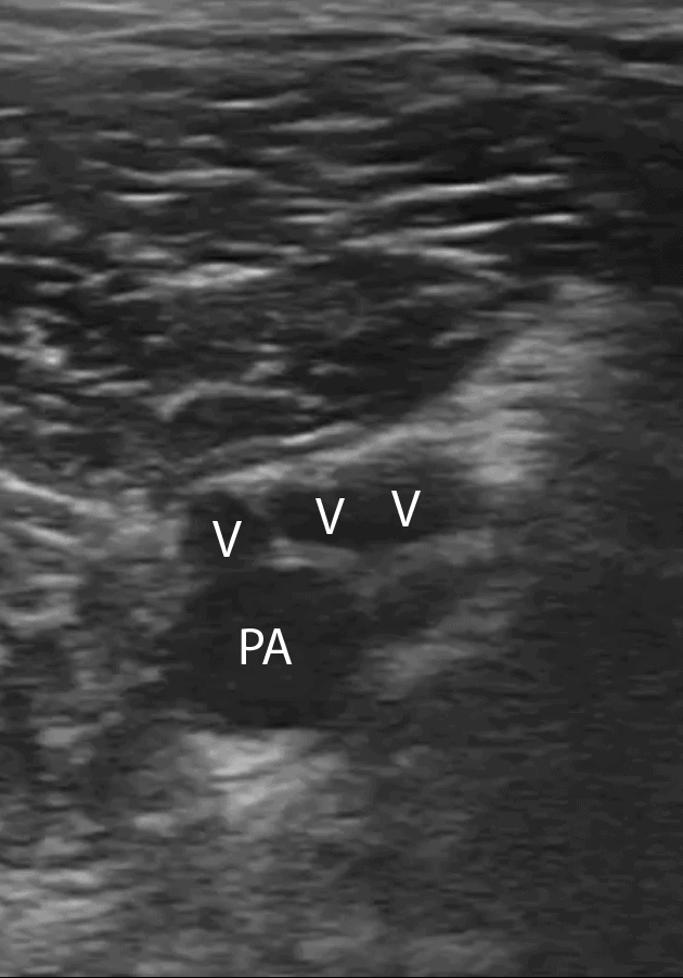 10 Continue to scan slightly more distal from the popliteal vein to find its trifurcation. https://pocus101.com/dvt 