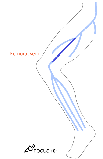 8 Slide the probe 1-2 cm down the patient’s leg to find where the CFV branches into the deep femoral vein and (superficial) femoral vein. Apply compression. https://pocus101.com/dvt 