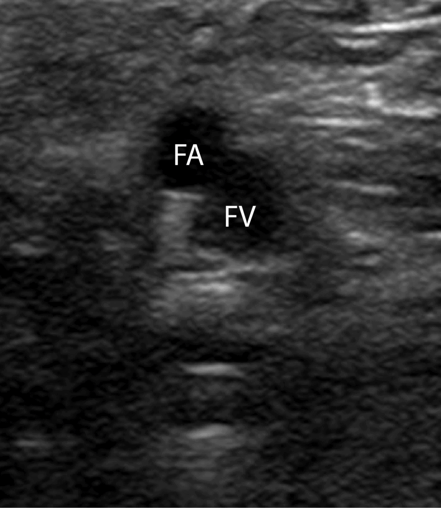 8 Slide the probe 1-2 cm down the patient’s leg to find where the CFV branches into the deep femoral vein and (superficial) femoral vein. Apply compression. https://pocus101.com/dvt 