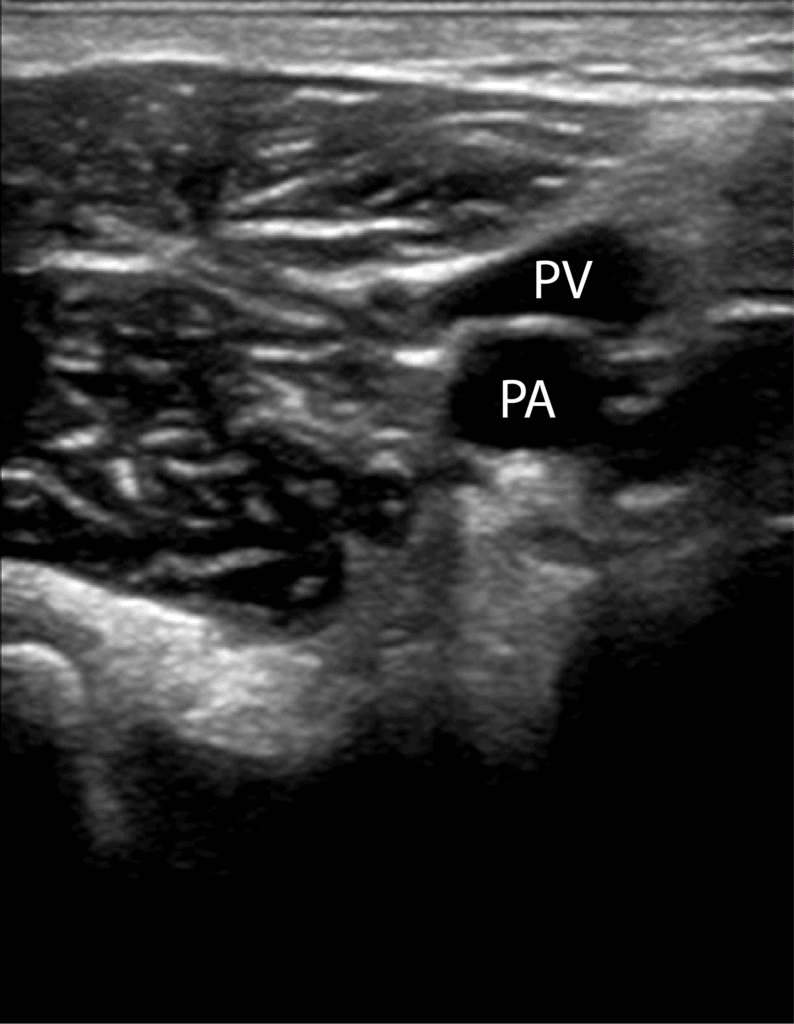 9 Move the probe into the posterior crease of the knee and scan 2 cm above and below to find the popliteal vein. Remember "Pop on Top." Apply compression. https://pocus101.com/dvt 