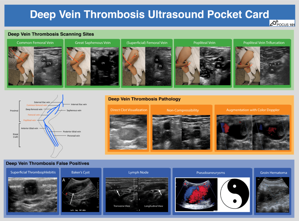 11 Deep vein thrombosis can be detected in two main ways using point of care ultrasound: direct clot visualization, non-compressibility of the vein. Download the PDF! https://pocus101.com/dvt 