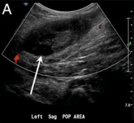16 A Baker’s cyst is a fluid-filled cyst in the popliteal bursa and can be a false positive.It appears as a circular anechoic mass with sharply defined borders in both the longitudinal and transverse view. On Color Doppler, there should be no flow. https://pocus101.com/dvt 