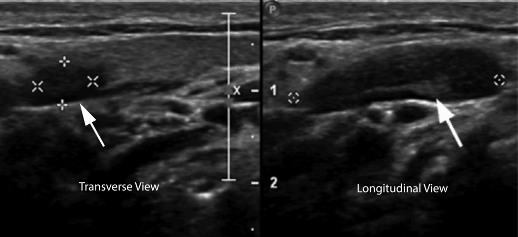 17 On ultrasound, a lymph node can look similar to a clot because it is a hypoechoic oval structure with a hyperechoic center. However, in the longitudinal view, a lymph node is circumscribed and not tubular in structure like a vein. https://pocus101.com/dvt 