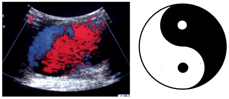 18 On ultrasound, pseudoaneurysms present as anechoic or hypoechoic images. With Color Doppler, you can see a “Yin-Yang Sign” from the circular motion of blood inside the pseudoaneurysm cavity. Don't confuse this for a non-compressible vein. https://pocus101.com/dvt 