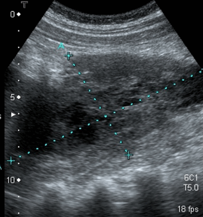 19 On ultrasound, a groin hematoma will be hypoechoic with some anechoic areas scattered throughout. If you scan the hematoma in the longitudinal view, it becomes obvious that the object is circumscribed and not tubular like a vein or artery. https://pocus101.com/dvt 