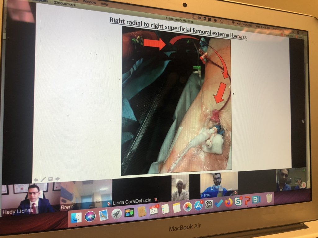 DrAnkitKPatel's tweet image. @HadyLichaaMD I am humbled at the simplicity of your idea and elegant, thoughtful and creative solution to a problem all of us in #LargeBore access struggle with. Balanced talk with pros and cons of all techniques! @crfheart @EpicSec @TCTConference
