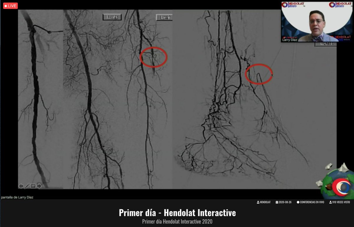 hendolat's tweet photo. SESIรN 3
SIMPOSIO ARTERIALIZACIรN DE MIEMBROS INFERIORES
#HENDOLATinteractive2020 ๐
#ProgramaAcademicoHENDOLAT
#CongresoAnualHENDOLAT
#somosHENDOLAT
#HENDOLAT2020
#HENDOLATbeyond
#HENDOLAT360 https://t.co/9tmBHtEYx9