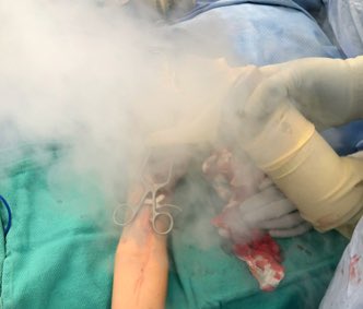  #Cryotherapy using liquid nitrogen