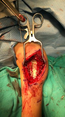 Cortical fibular allograft cut into 6 thin segments and placed as intramedullary struts