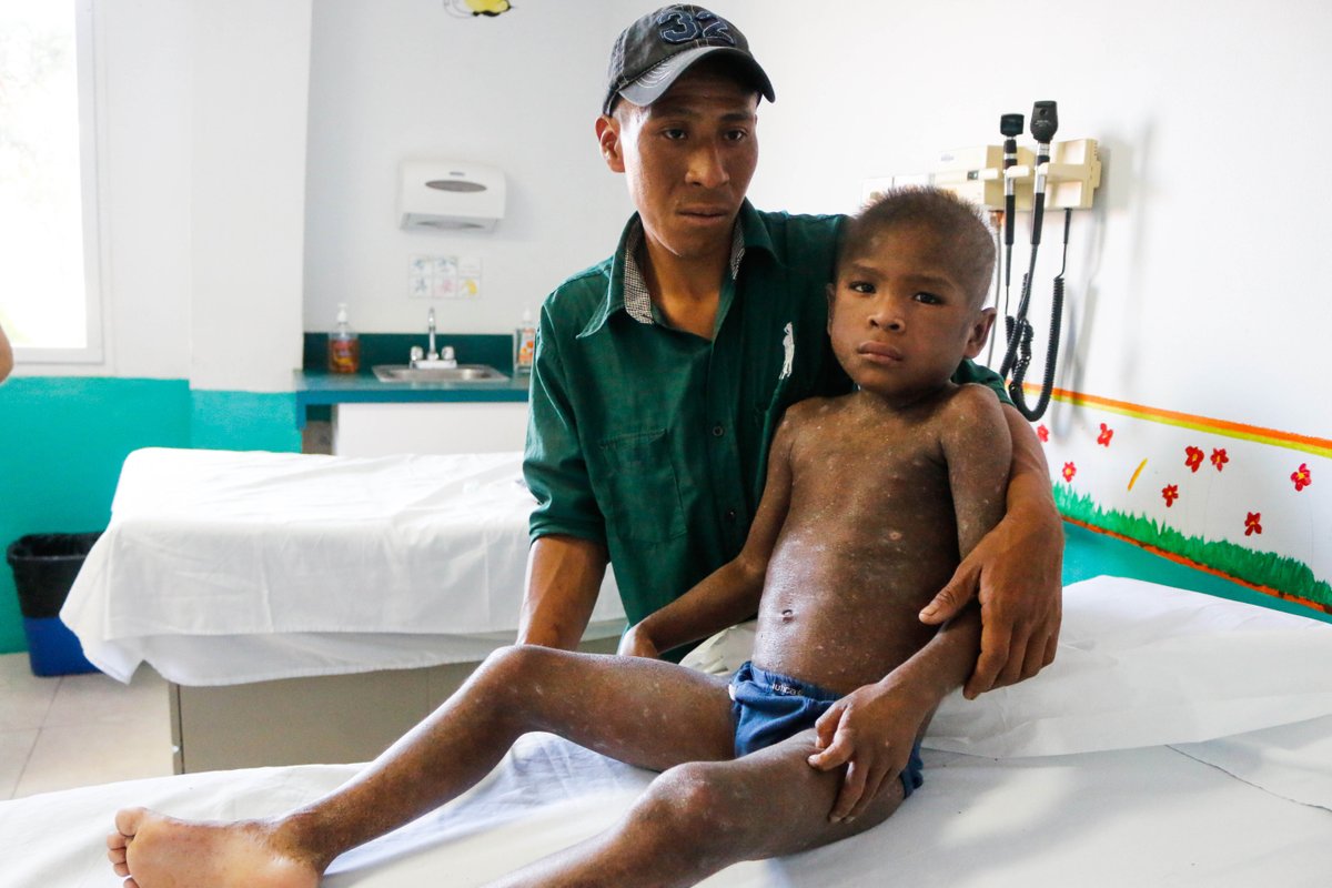 HopeofLife_Intl's tweet photo. Aroldo came to HOL in March of 2018. At the time, the 7yo weighed less than 40lbs. After TWO YEARS of nutrition, occupational and skin  therapies, Aroldo is a different boy. HUGE shout out to our staff at  St. Luke's Nutritional Recovery Center!  🏥   🤒. ⛰️ https://t.co/IRyIUBfEY7