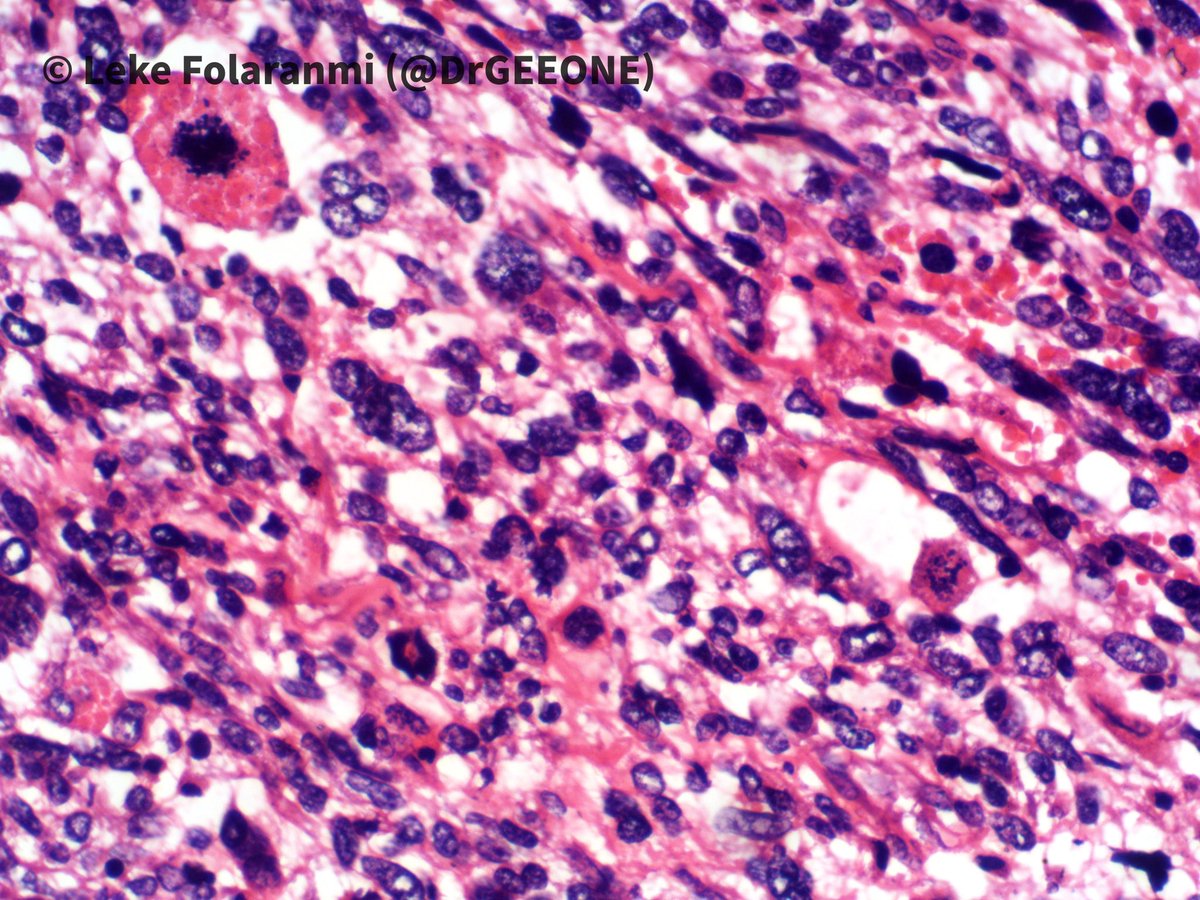 DrGeeONE's tweet photo. 1/2
Nephrectomy specimen from a young adult female who presented with haematuria, abdominal pain and loss of weight
Kindly share your opinions
-Case shared with me by my colleagues @rafiu1433 @EhizDr
#GuPath
cc: @AMubeen_Path @nucleololailo @TheKarenPinto @padmapathology1 https://t.co/5QMzgBg6cY