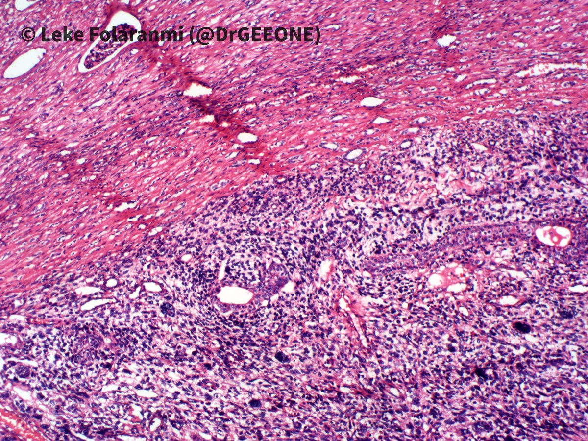 DrGeeONE's tweet photo. 1/2
Nephrectomy specimen from a young adult female who presented with haematuria, abdominal pain and loss of weight
Kindly share your opinions
-Case shared with me by my colleagues @rafiu1433 @EhizDr
#GuPath
cc: @AMubeen_Path @nucleololailo @TheKarenPinto @padmapathology1 https://t.co/5QMzgBg6cY
